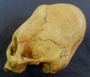 Left side. Note four extra bones in the temporal suture.