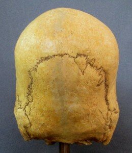 The suture between the parietal and occipital in normal skulls is a low curve. In this one, the suture is tall and almost rectangular. Note also the "Inca bone", the heart-shaped extra bone, common in some Incan skulls. This woman had two!